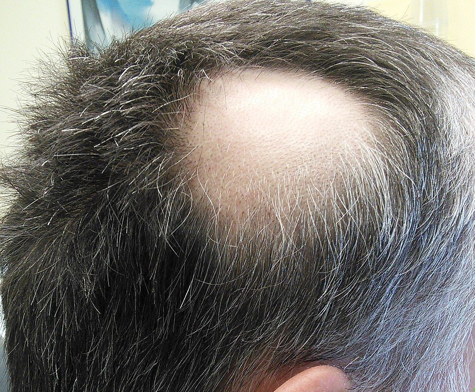 do dmards cause hair loss